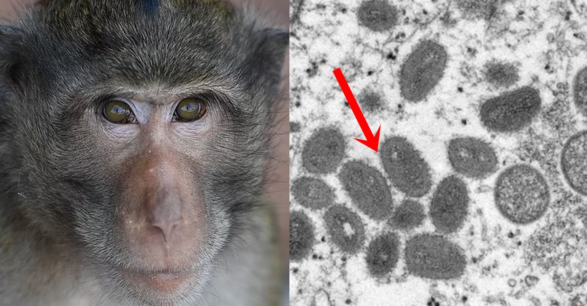 [속보] 치사율 10% 원숭이두창 바이러스 전세계 확산 중