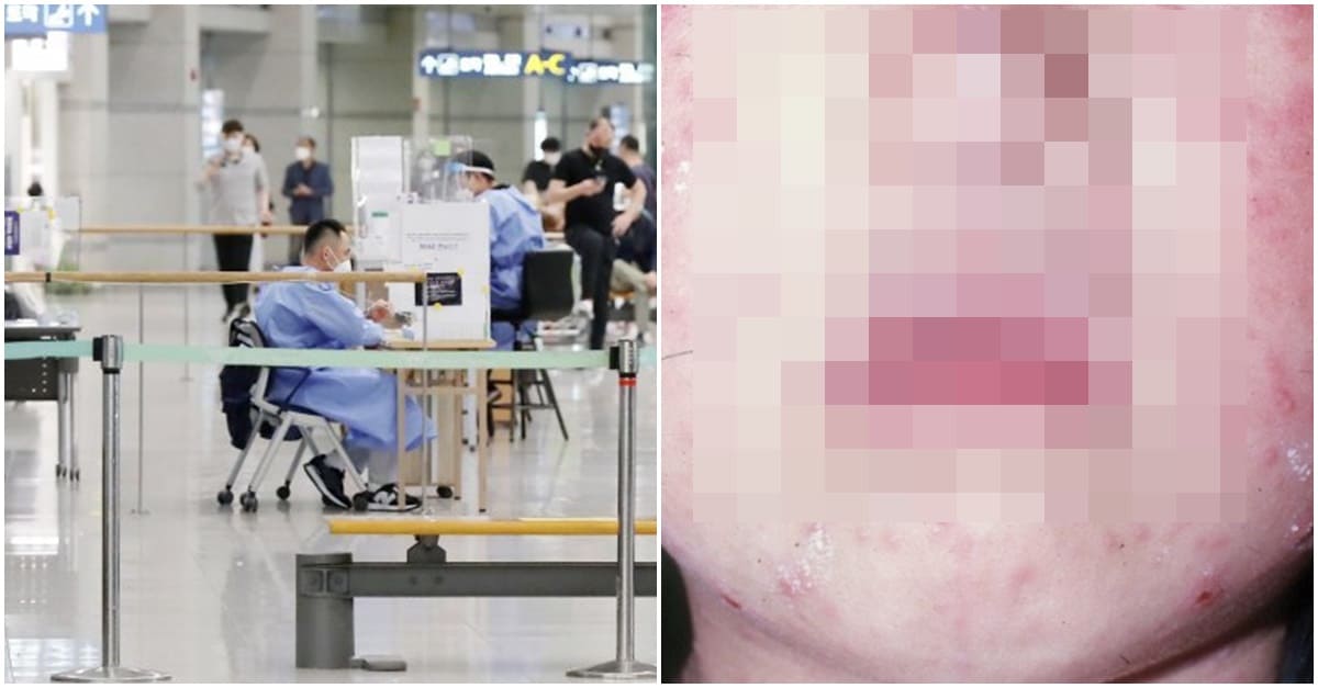 실시간 인천 원숭이두창 국내 감염 의심 심각한 이유 (+증상, 백신, 치사율)